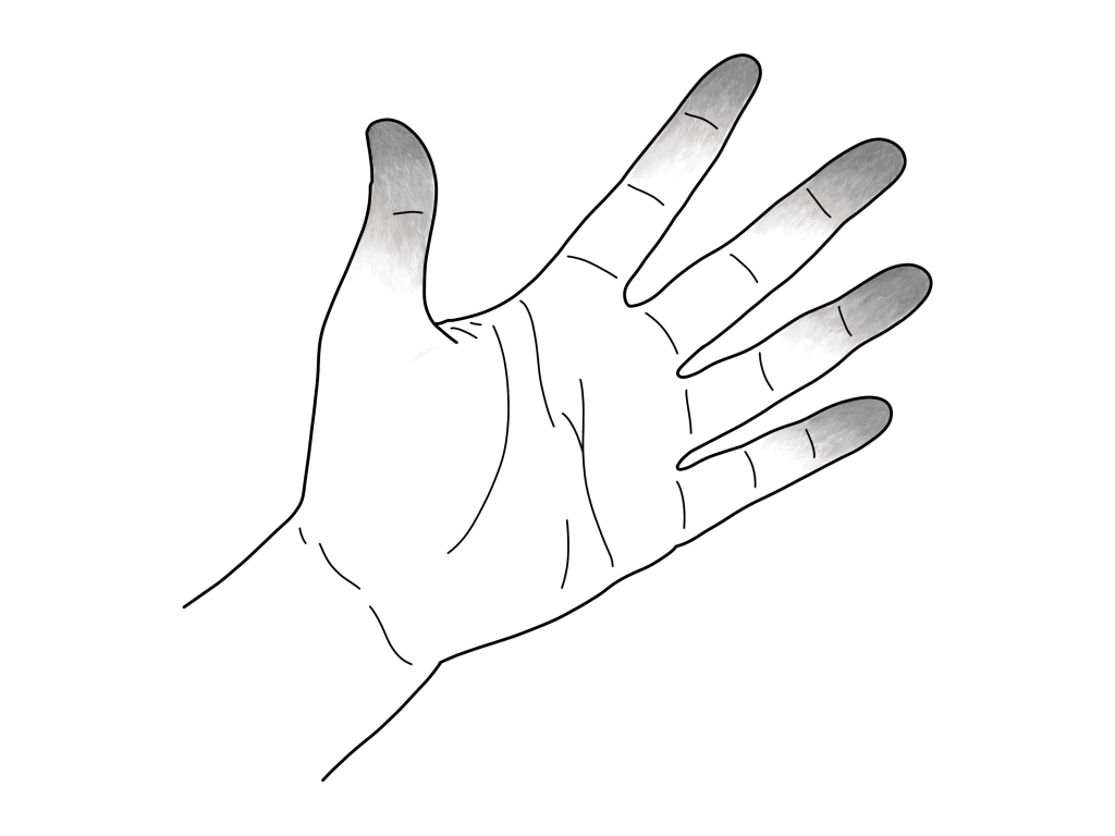 Illustration of fingertips affected by superficial cold injury (frostnip)