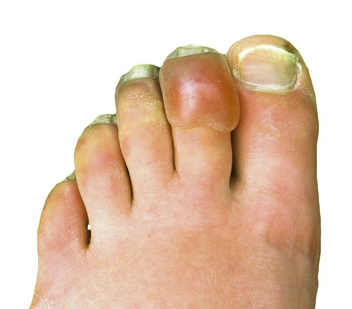 Frostbitten toes with discolored, swollen tips