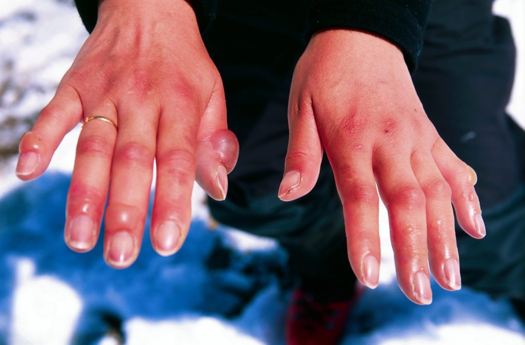 Frostbitten fingers, red and swollen with early blisters after thawing