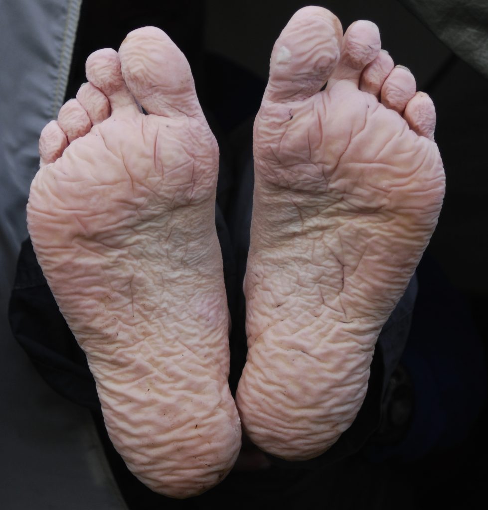 Pale, deeply wrinkled soles from prolonged cold and wet exposure (trench foot)